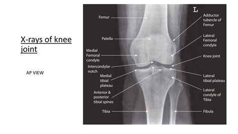 RADIOGRAPHIC ANATOMY OF KNEE JOINT AND ITS RADIOGRAPHIC VIEWS.pptx