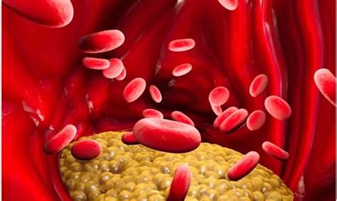Pegozafermin significantly reduces triglyceride levels in severe ...