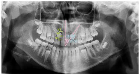 Comparisons of Two Different Treatment Methods for Impacted Maxillary Canines: A Retrospective Study
