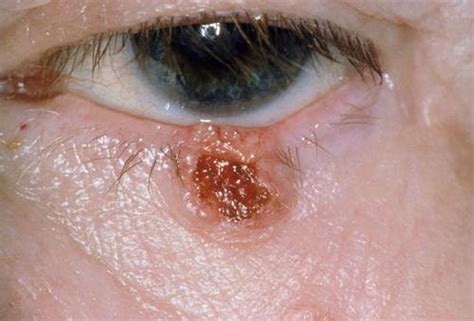 Image:Basal Cell Carcinoma of Eyelid-Merck Manual Consumer Version