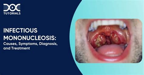Infectious Mononucleosis | Causes, Symptoms, Diagnosis, and Treatment