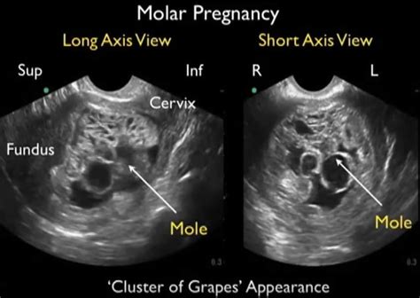 Molar Pregnancy, Hydatidiform Mole - Causes, Symptoms, Treatment