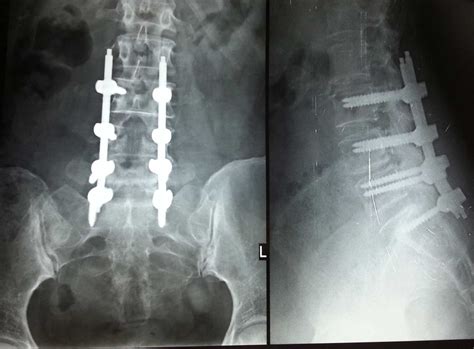 Bulging Disc Surgery 的图像结果
