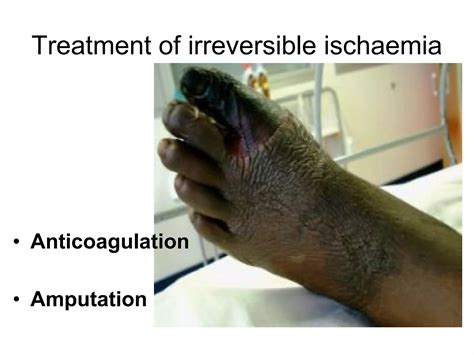 Acute limb ischemia | PPT