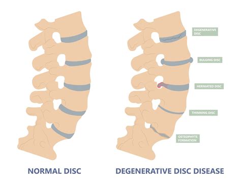 Lumbar Degenerative Disk
