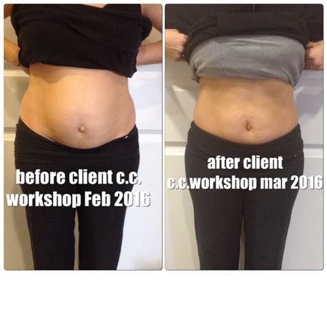 Albums 90+ Pictures Apron Belly Before And After Pictures Latest