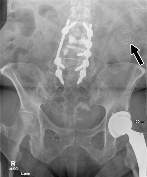 Interventional Radiology Placement and Management of Tunneled Peritoneal Dialysis Catheters: A ...