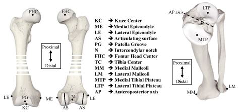 Modified Whiteside’s Line-Based Transepicondylar Axis for Imageless Total Knee Arthroplasty