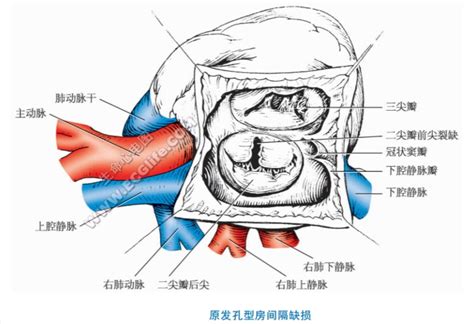 先天性房间隔缺损与手术修补过程 - 好医术早读文章 - 好医术-赋能医生守护生命