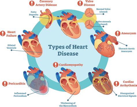 Heart Disease: Diagnosis and Treatment - Pulse Cardiology