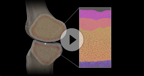 Articular Cartilage Injury — Jonathan Koscso, MD