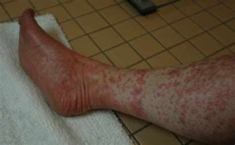 my atripla rash experience: day 12