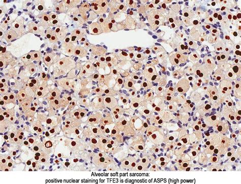 Pathology Outlines - Alveolar soft part sarcoma