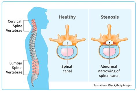 Cervical Spinal Stenosis - Symptoms, Causes, Treatments