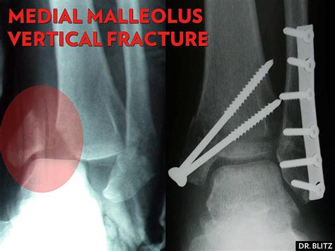 5 Kinds of Medial Malleolus Ankle Fractures