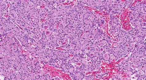 Neuroendocrine tumour - Pathology dictionary - MyPathologyReport.ca