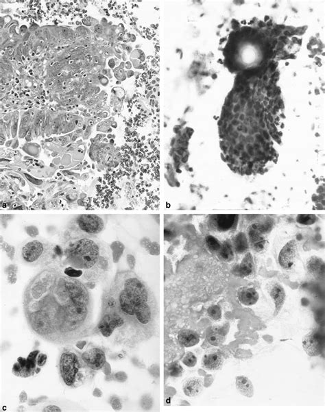The cytomorphology of papillary serous carcinoma of the endometrium in cervical smears - Wright ...