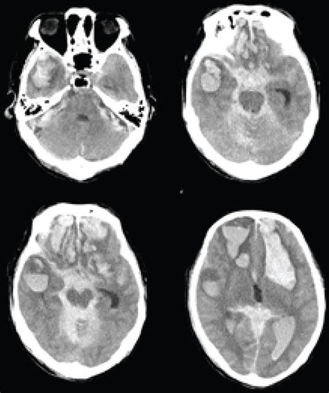 'Talk and Die' with Potential Medicolegal Issue: A Case and Literature ...