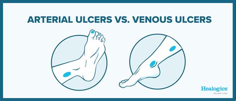 Arterial vs. Venous Ulcers: What Are the Differences? | Healogics