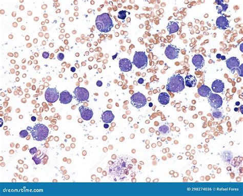 Pleural Lymphoma, Cytology. Stock Photo - Image of large, laboratory: 298274036