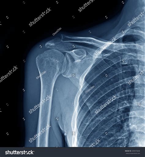 Shoulder Joint X Ray