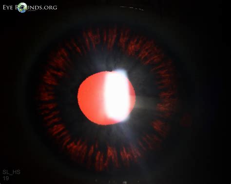 Pigmentary Dispersion Syndrome