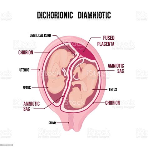 Dichorionic Diamniotic Twins With Fused Placenta Stock Illustration ...