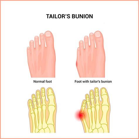 Tape Tailor Bunion at Vera Malone blog