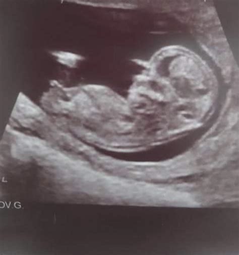 12 weeks + 2 days ultrasound. Boy or girl? : r/nubtheory
