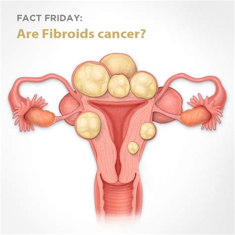 Fact Friday - Fibroid Treatment Clinic