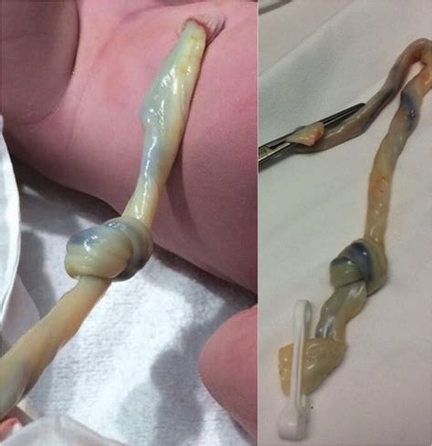 True Knot In Umbilical Cord