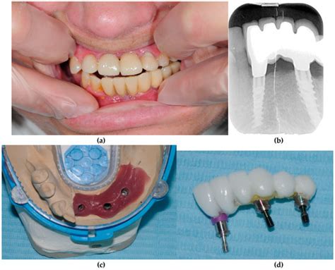 Metallothioneins in Failure of Dental Implants and Periodontitis Down ...