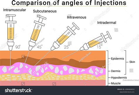 Intradermal Injection