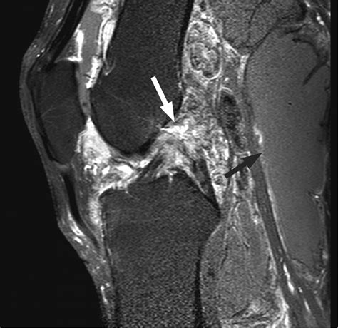 The management of diffuse-type giant cell tumour (pigmented villonodular synovitis) and giant ...