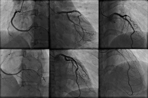 Detecting Ischemia in Myocardial Bridging With CT Angiography-Derived ...