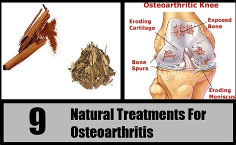 9 Natural Treatments For Osteoarthritis | Search Herbal & Home Remedy