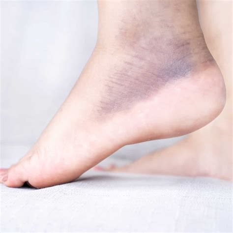 Warning Signs of Bone Cancer: Symptoms, Signs & Treatment