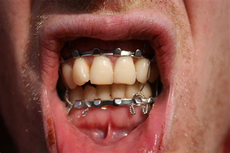 Wire Jaw Shut Mortuary Assistant at William Deas blog