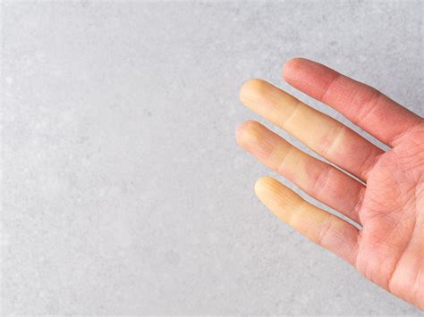 Raynaud’s Disease | Family Doctor