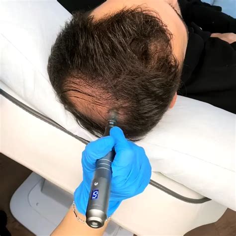 Microneedling for Hair Loss - Enhance Skin London