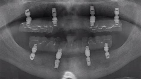 BICON - Implantate | heico Dent
