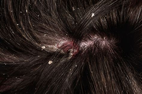 Scalp Dandruff 的图像结果