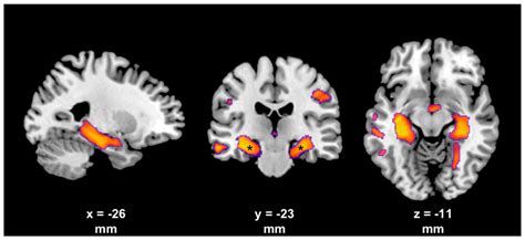 Central Effects of Botulinum Neurotoxin—Evidence from Human Studies