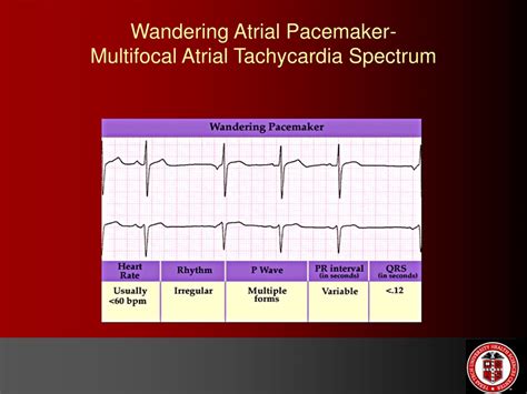 Wandering Atrial Pacemaker