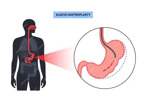How Much Weight Can You Lose With Endoscopic Sleeve Gastroplasty at Bridget Mireles blog