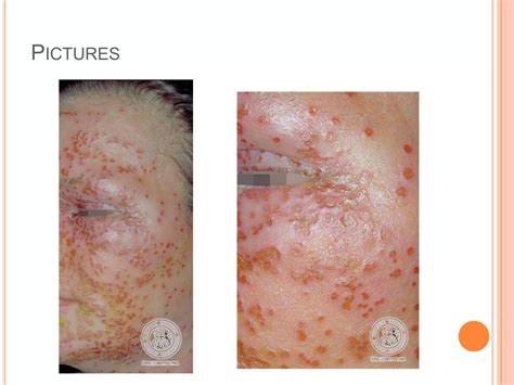 Case presentation eczema herpeticum | PPTX