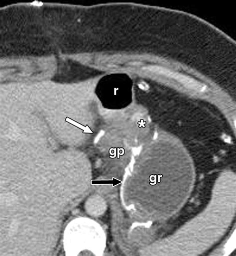 Imaging in Bariatric Surgery: A Guide to Postsurgical Anatomy and Common Complications | AJR