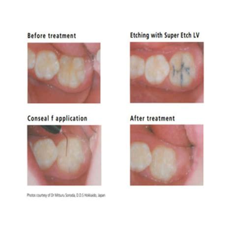 SDI Conseal F - Fluoride Releasing Pit & Fissure Sealant by Dental Avenue