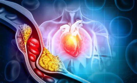 High Cholesterol Can Damage Your Heart: Here Is What Happens In Your Body When Bad Cholesterol ...