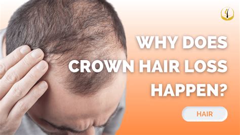 Why Does Crown Hair Loss Happen? - Hair Transplant At GloJas